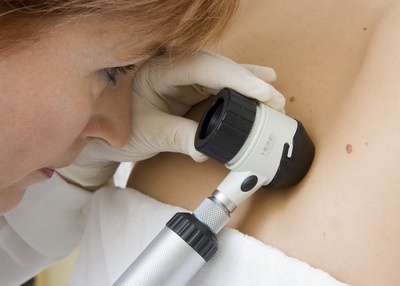 bőrgyógyászat - anyajegyszűrés