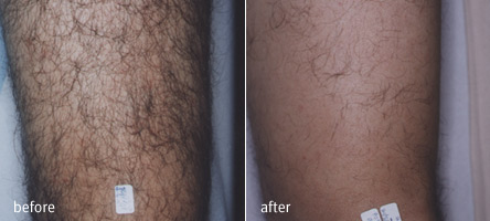 Gyógynövényes mélyhámlasztás,Dermanutrics termékcsalád,Nappali és éjszakai krémek,Villanófényes szőrtelenítés