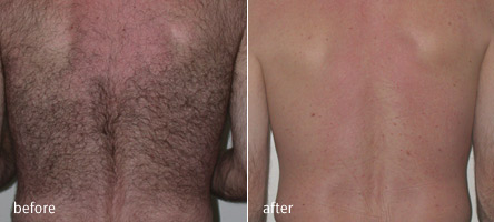 Gyógynövényes mélyhámlasztás,Dermanutrics termékcsalád,Nappali és éjszakai krémek,Villanófényes szőrtelenítés